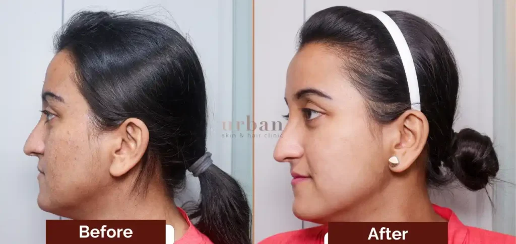 rupal singh acne after before result