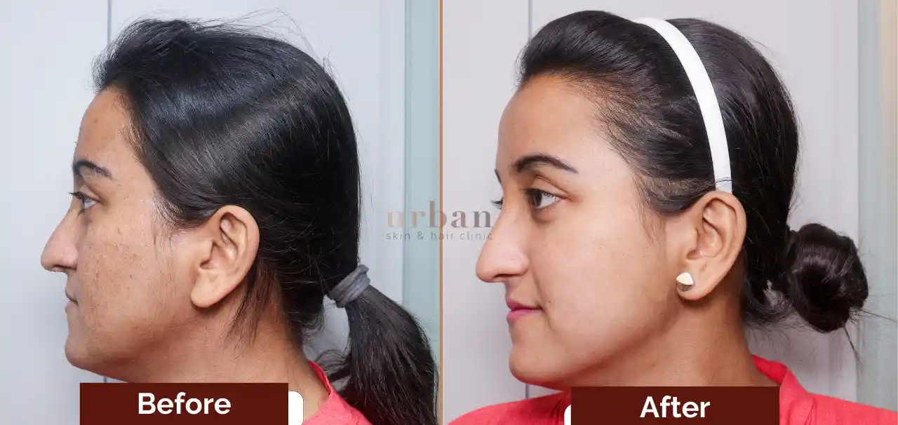 Homes 16 acne treatment for female