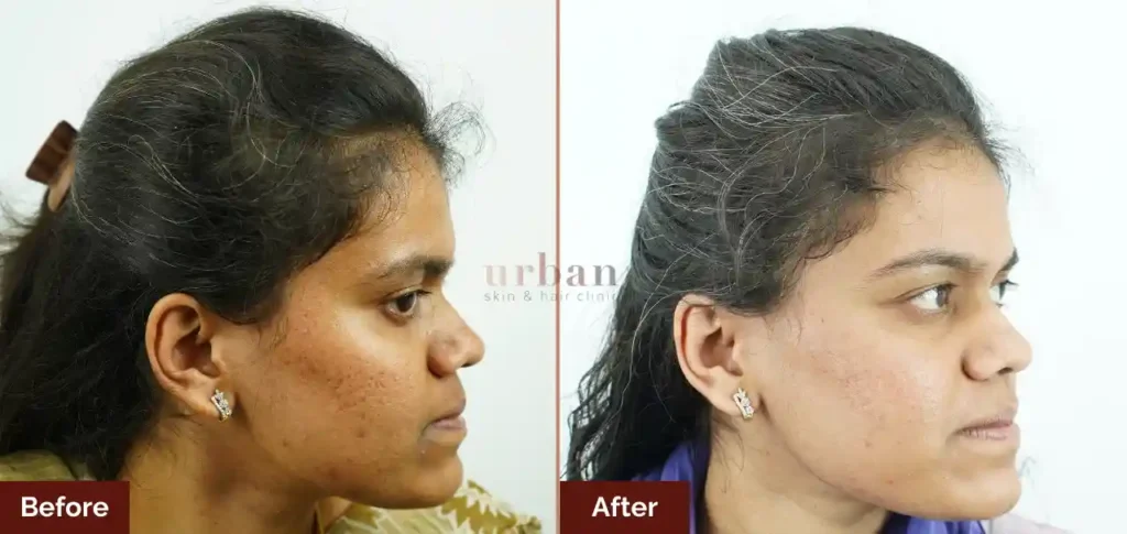 suchita gawade acne + scar after before result