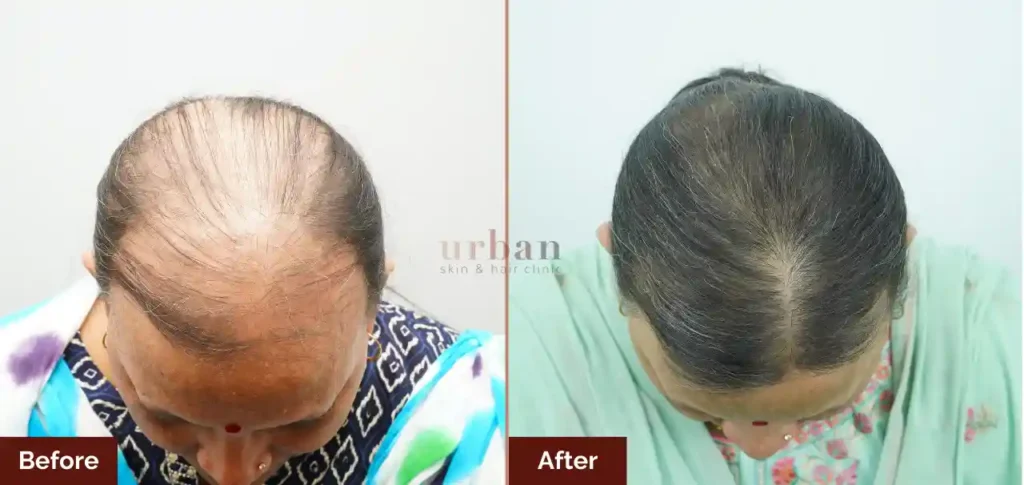 surekha chavan female hairloss after before result