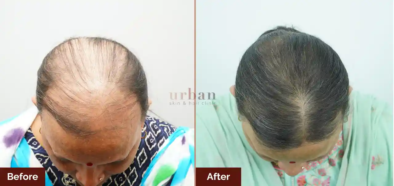 Homes 22 Female hair loss treatment