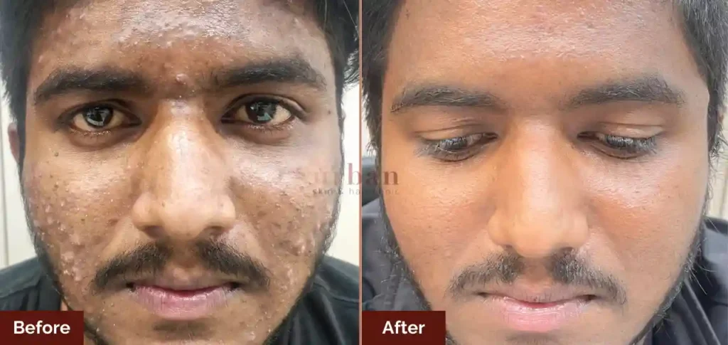 tejas jadhav pigmentation after before result