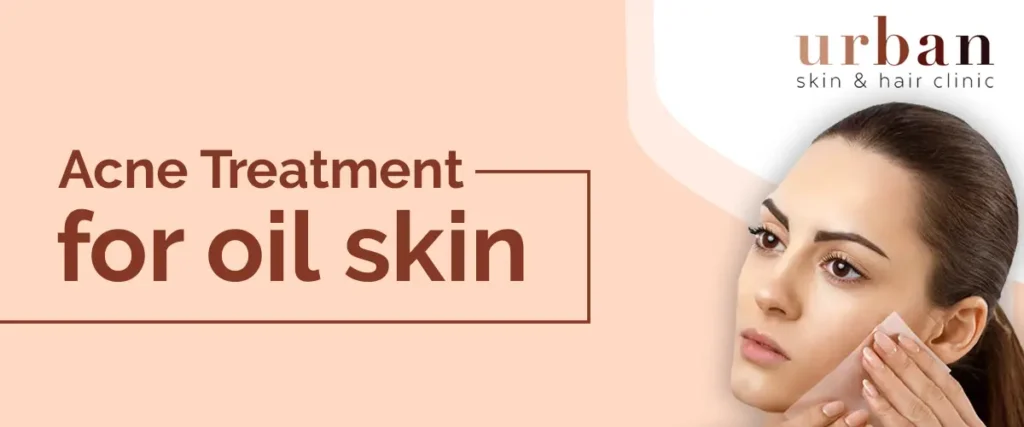 Acne Treatment for oil skin