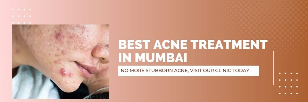 Acne treatment in Mumbai