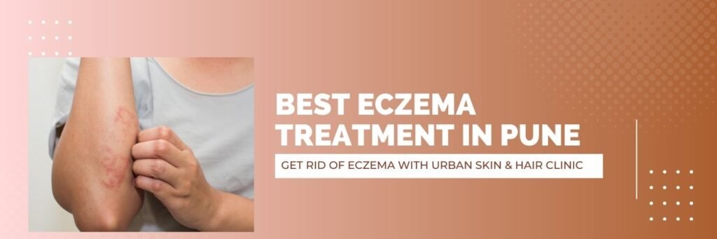Eczema treatment near me