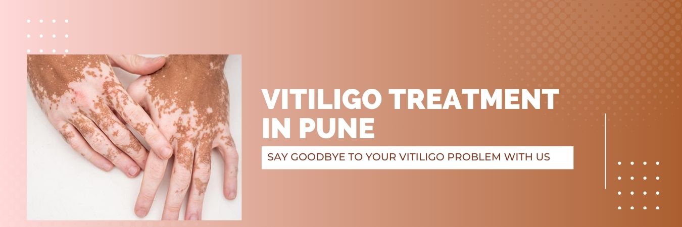 Vitiligo treatment in Pune