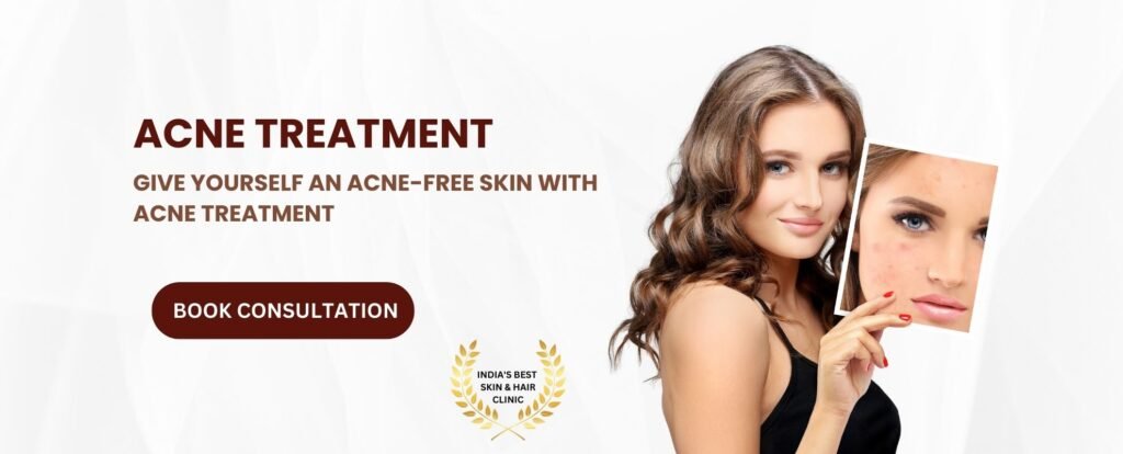 acne treatment