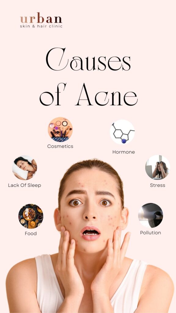 Causes of Acne