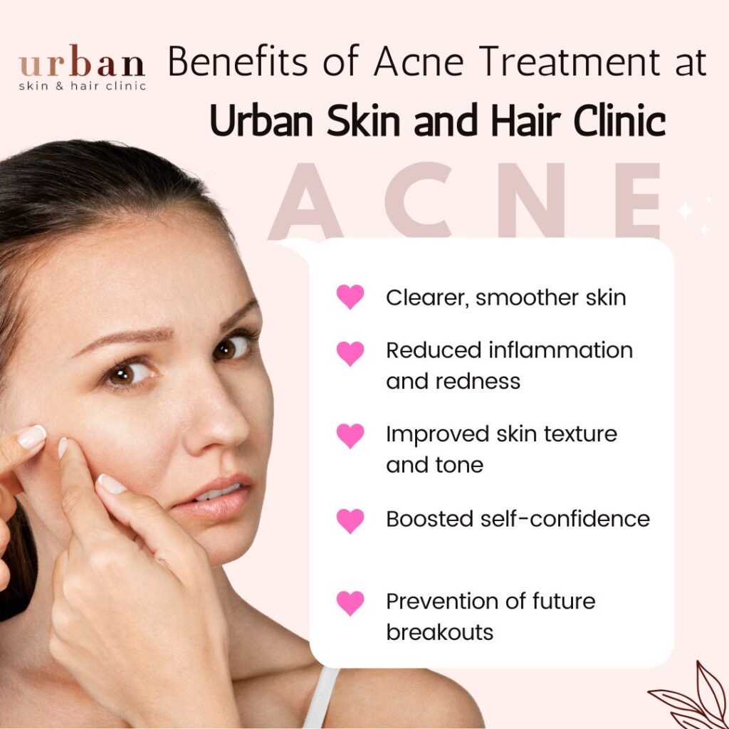 Benefits of Acne treatment