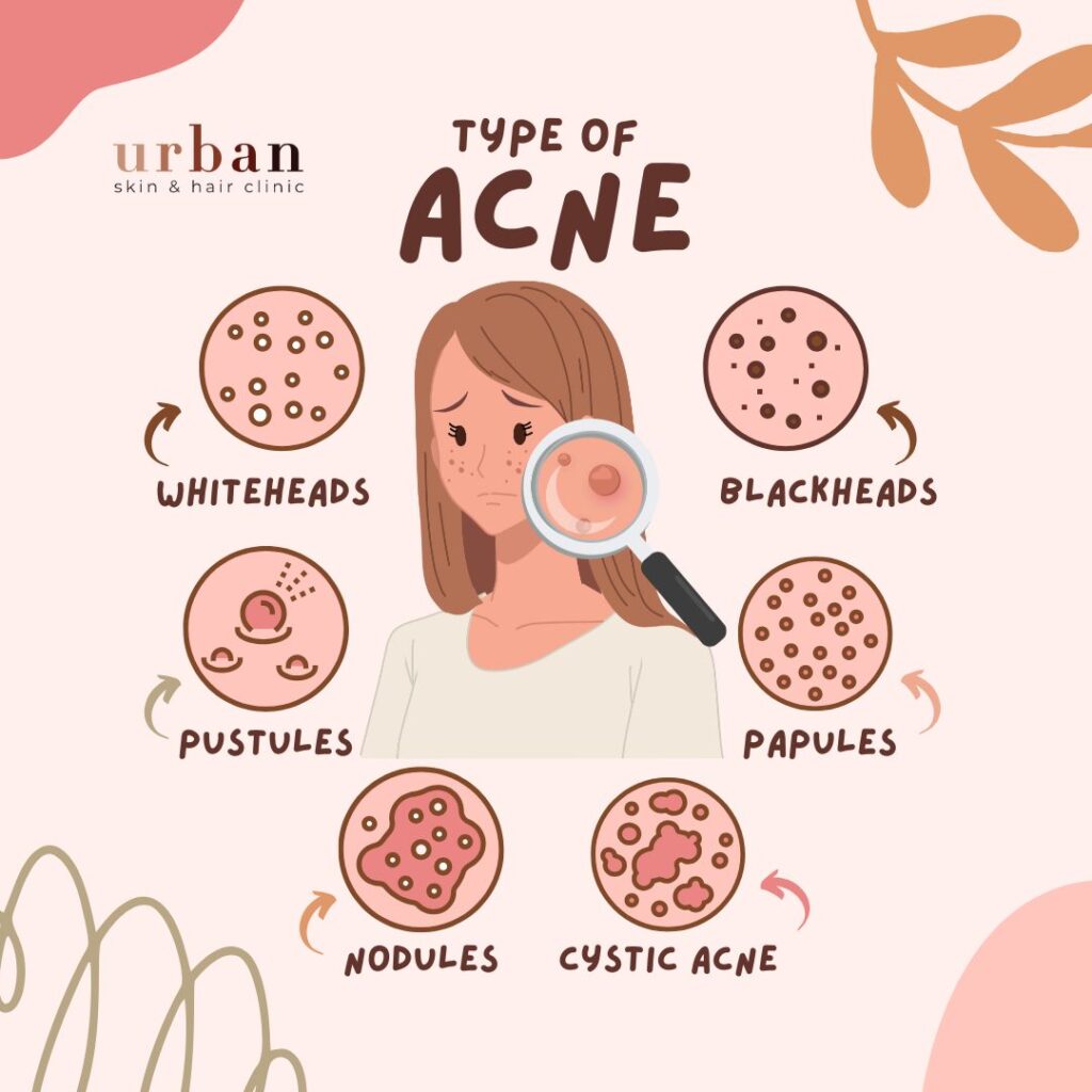 Types of Acne