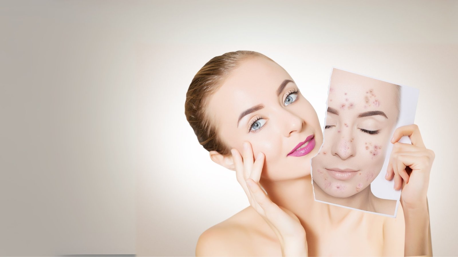 Homes 5 Acne scars min