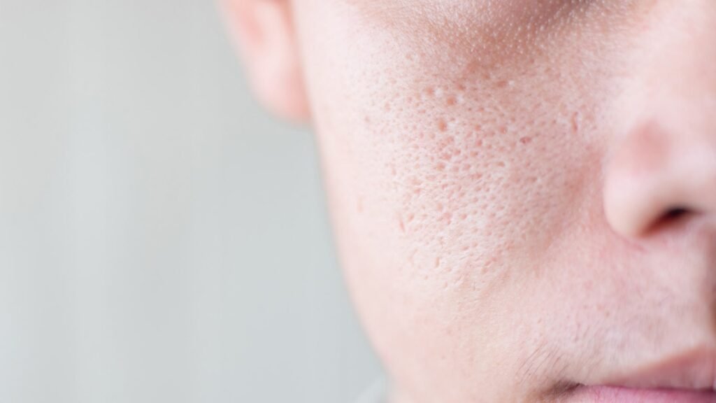 open pores treatment in Pune, best open pores treatment in Pune, advanced open pores treatment in Pune, open pores clinic in Pune, laser treatment for open pores in Pune