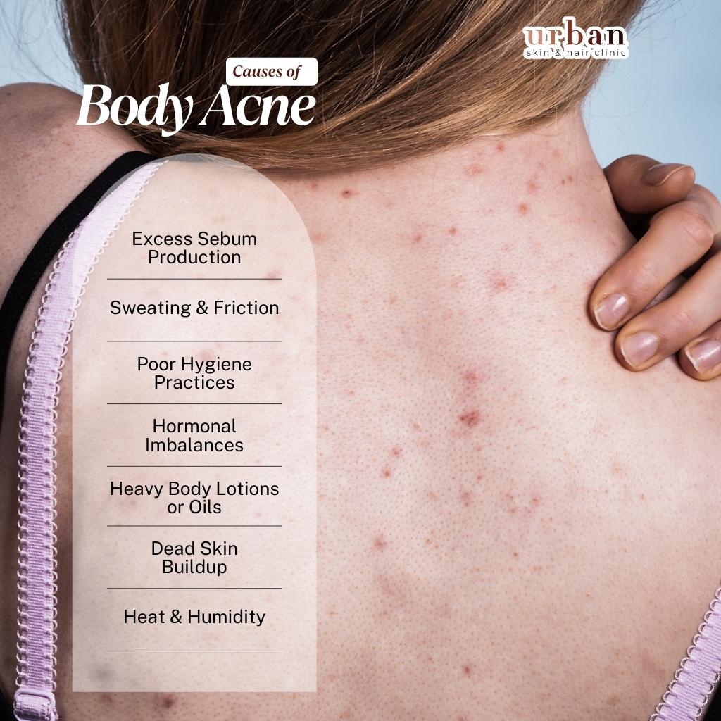 Causes of Body Acne