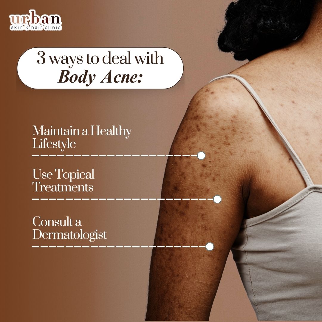 causes of body acne