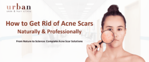 acne scar treatment