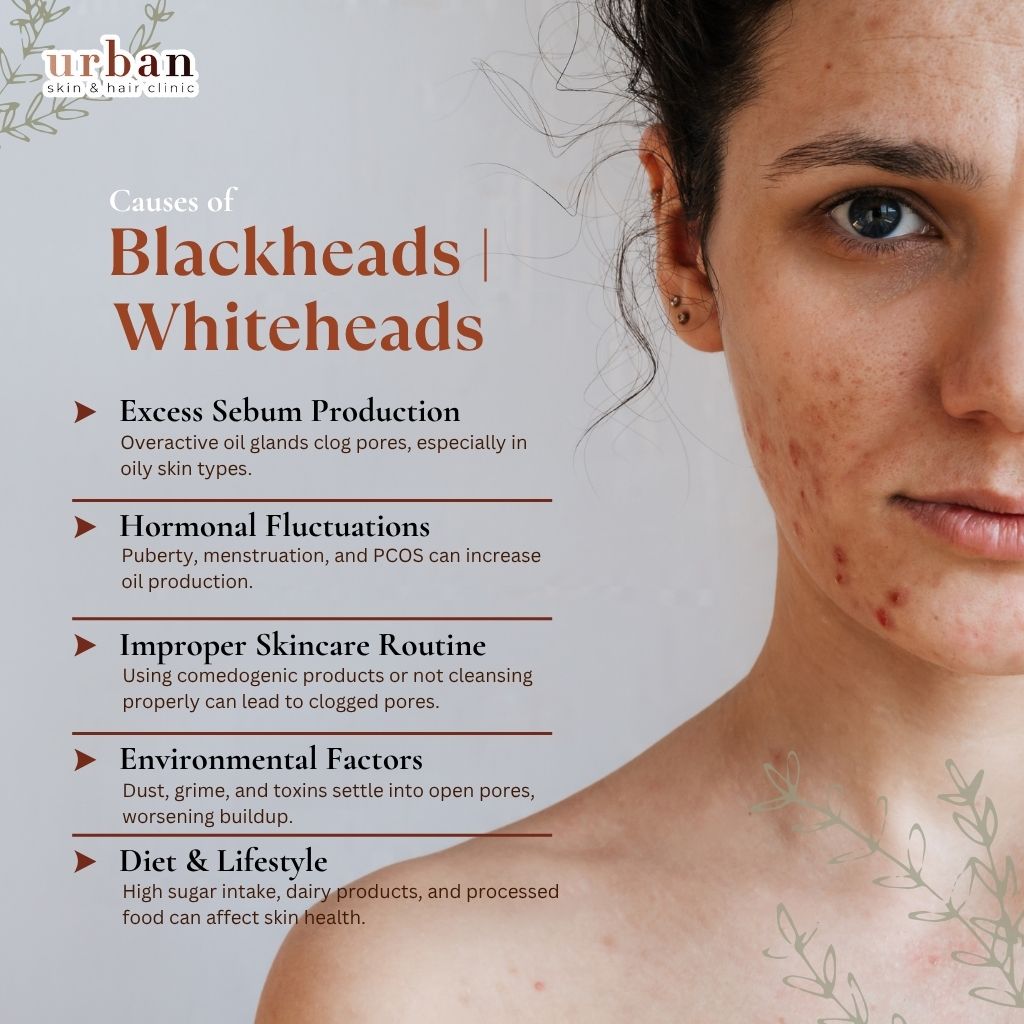 Causes of blackheads and whiteheads