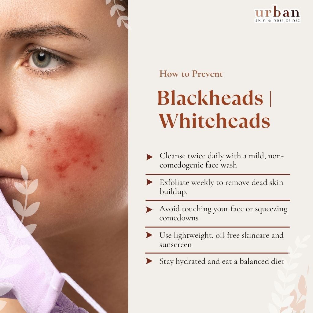 How to Prevent Blackheads & Whiteheads