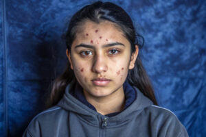 Acne scare