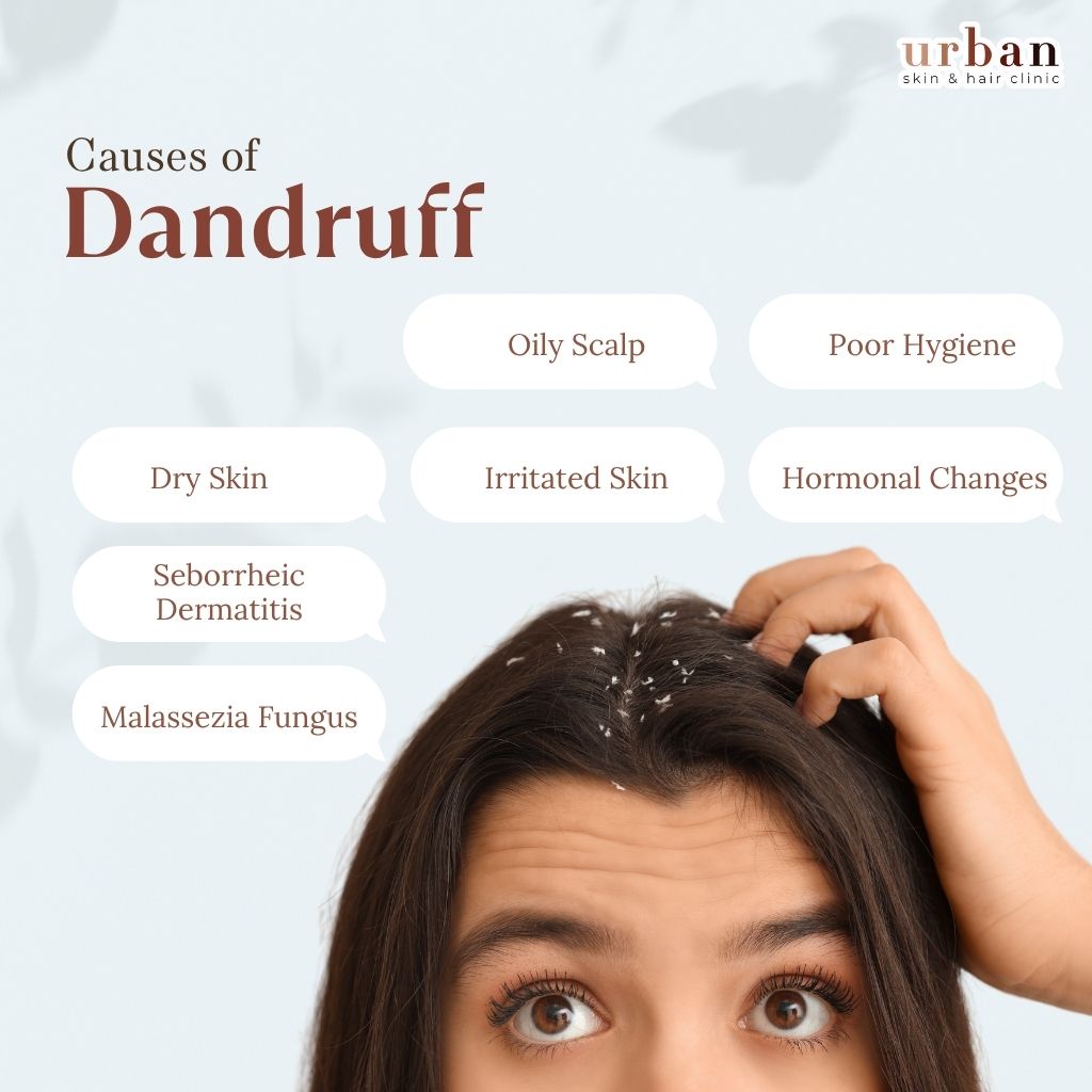 Causes of Dandruff