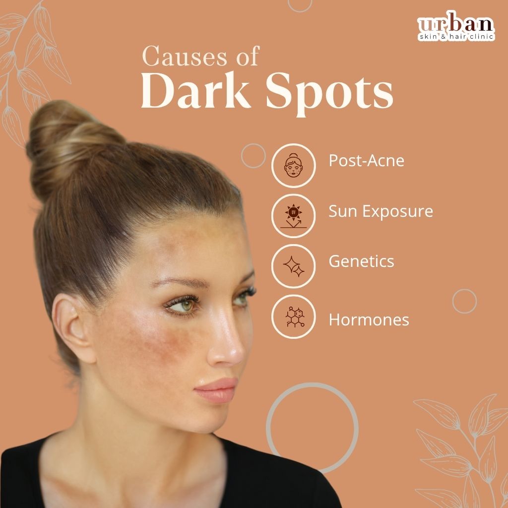Causes of dark spot