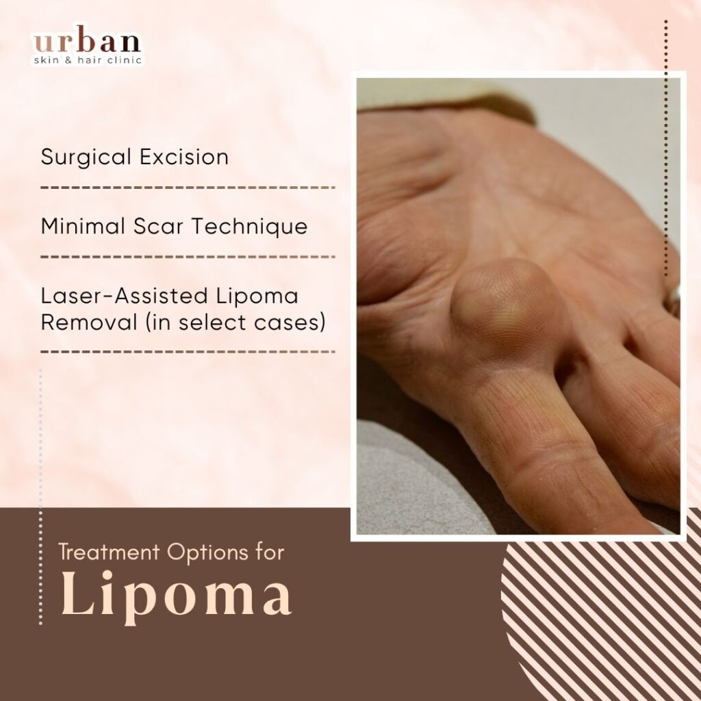 Treatment options for Lipoma