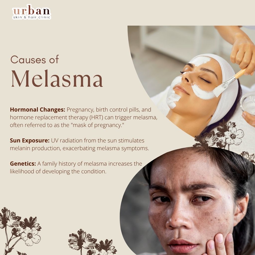 Causes of Melasma
