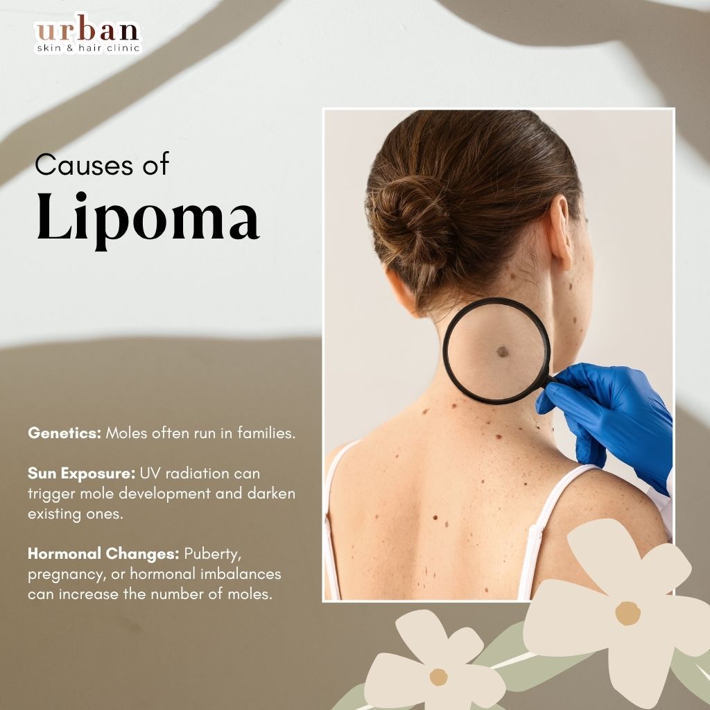 Causes of Moles