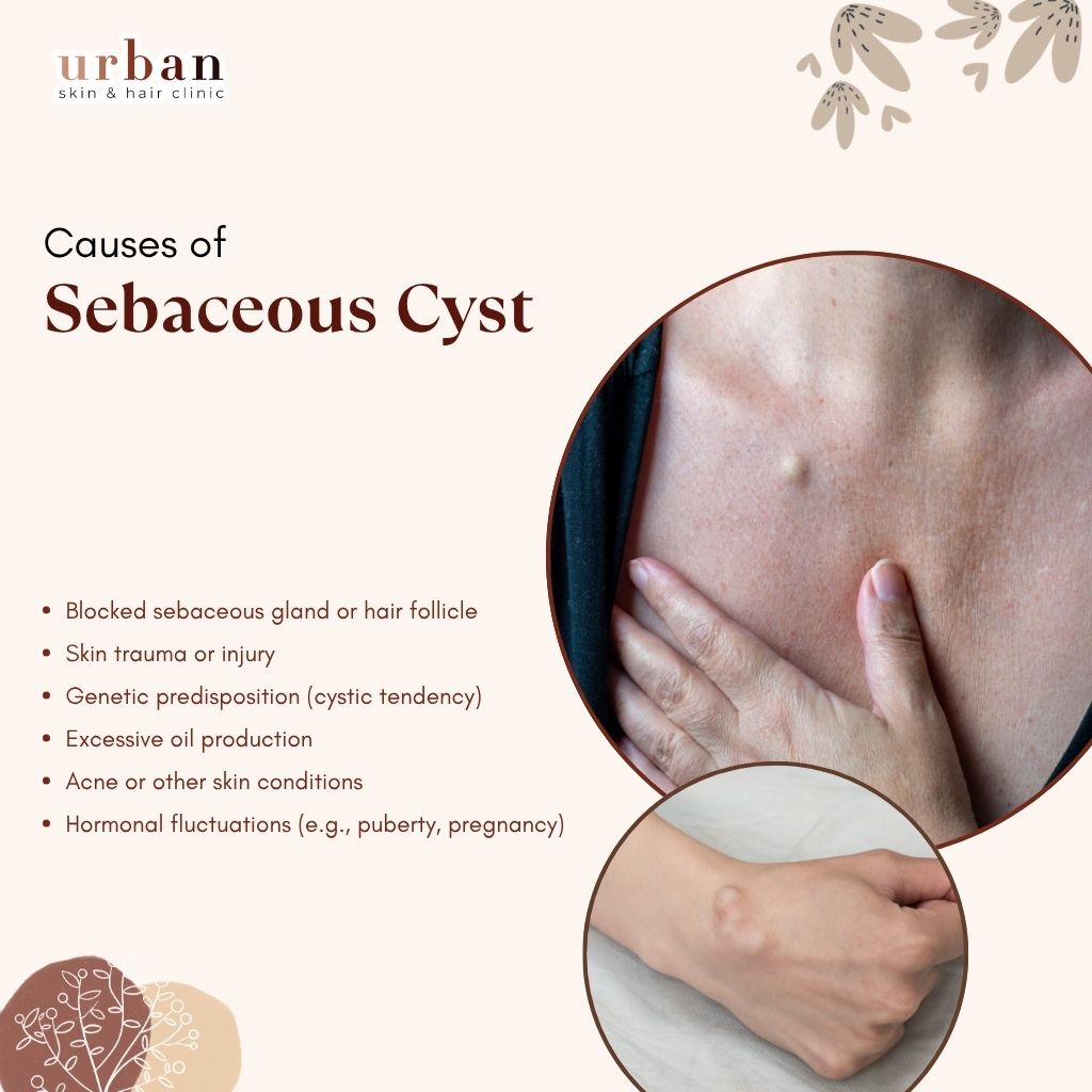Causes of Sebaceous Cyst​