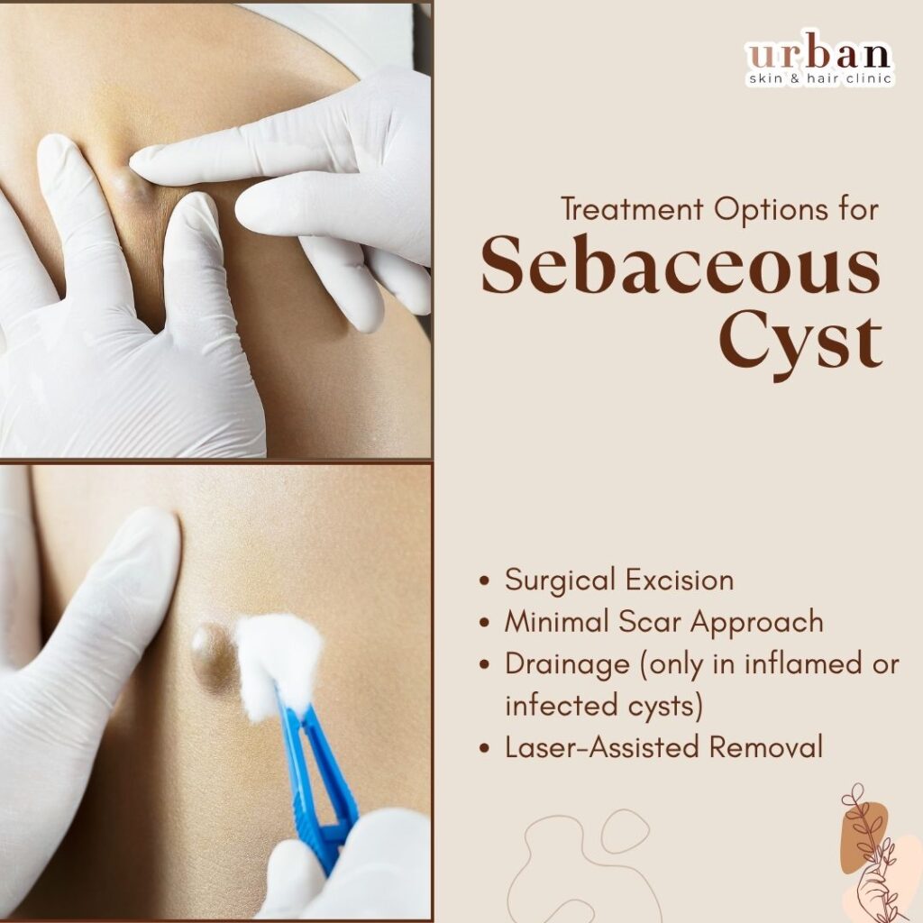 Treatment for Sebaceous Cysts