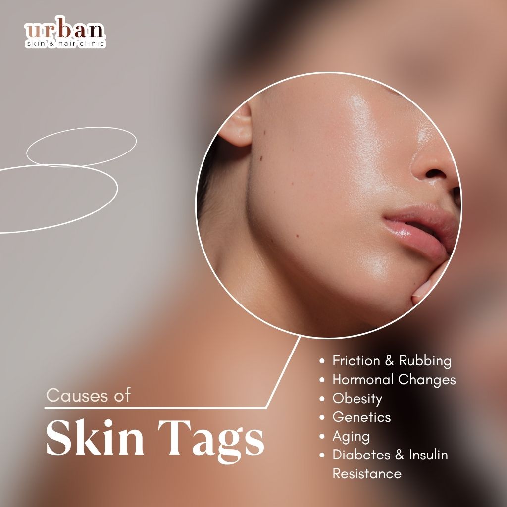 Causes of Skin Tags