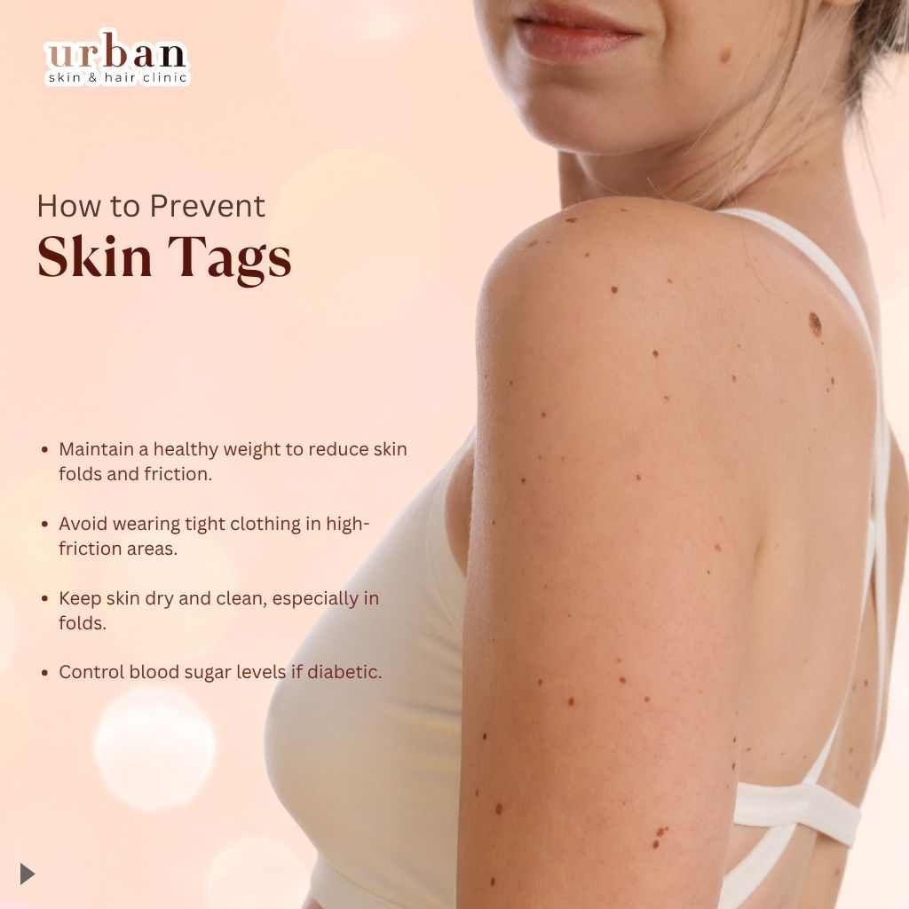 How to Prevent Skin Tags