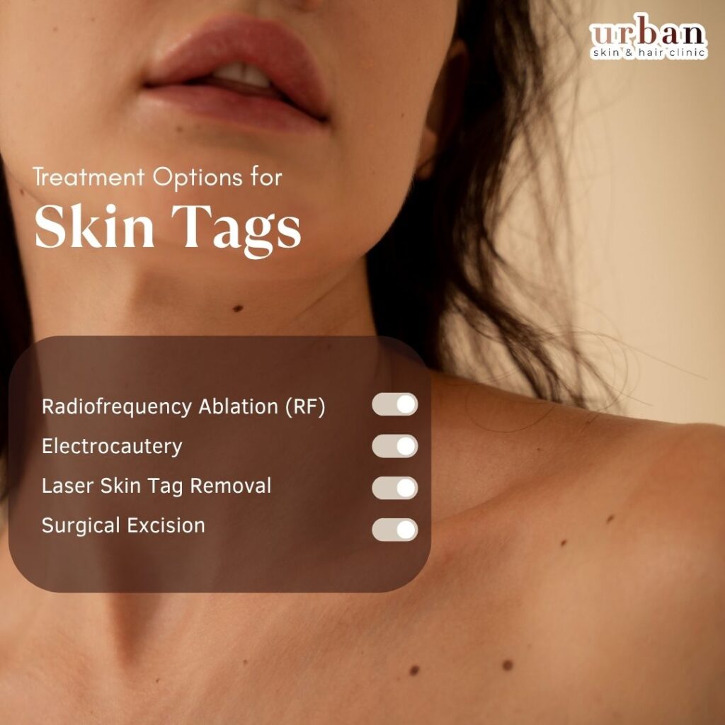 treatment for Skin Tags