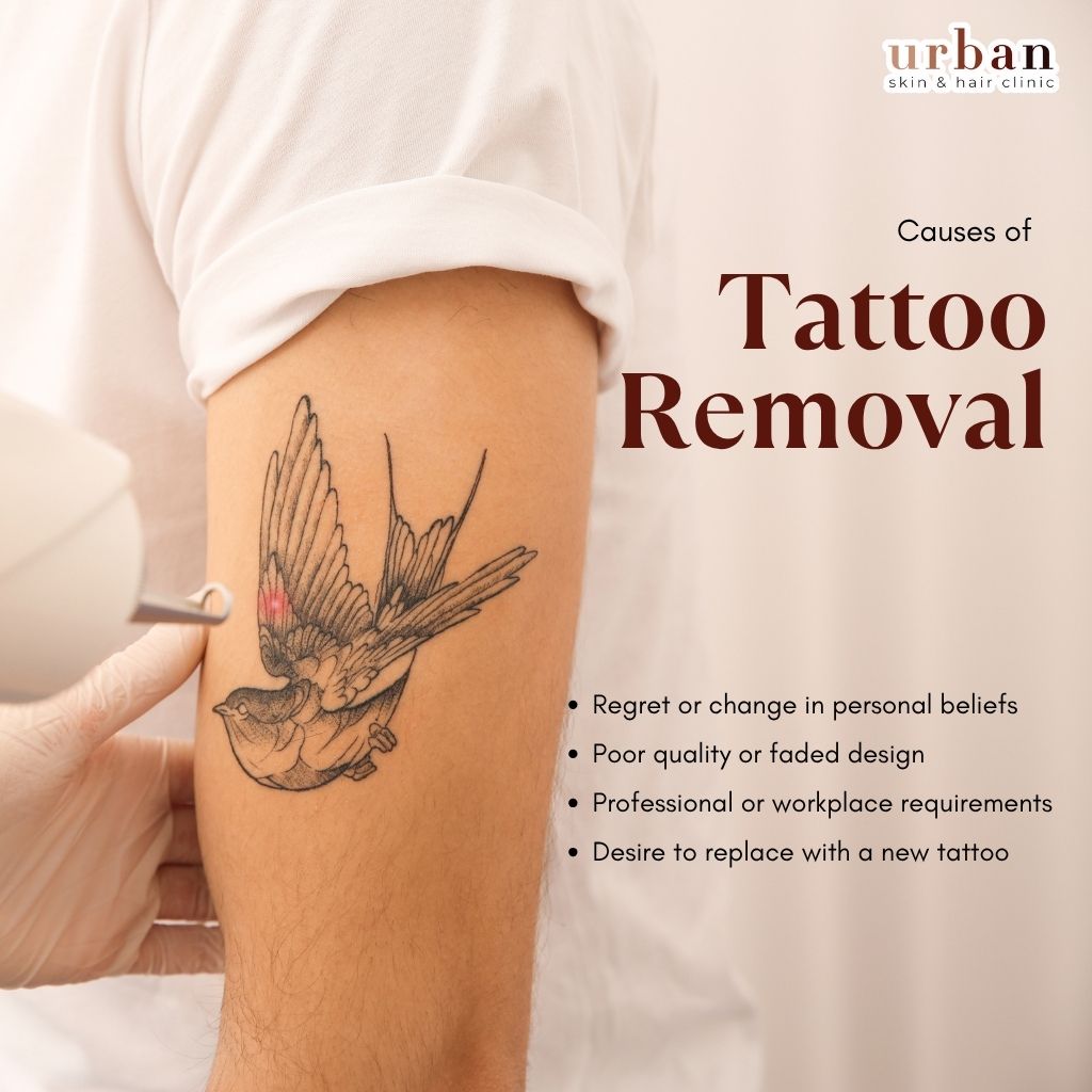 Causes for Tattoo Removal