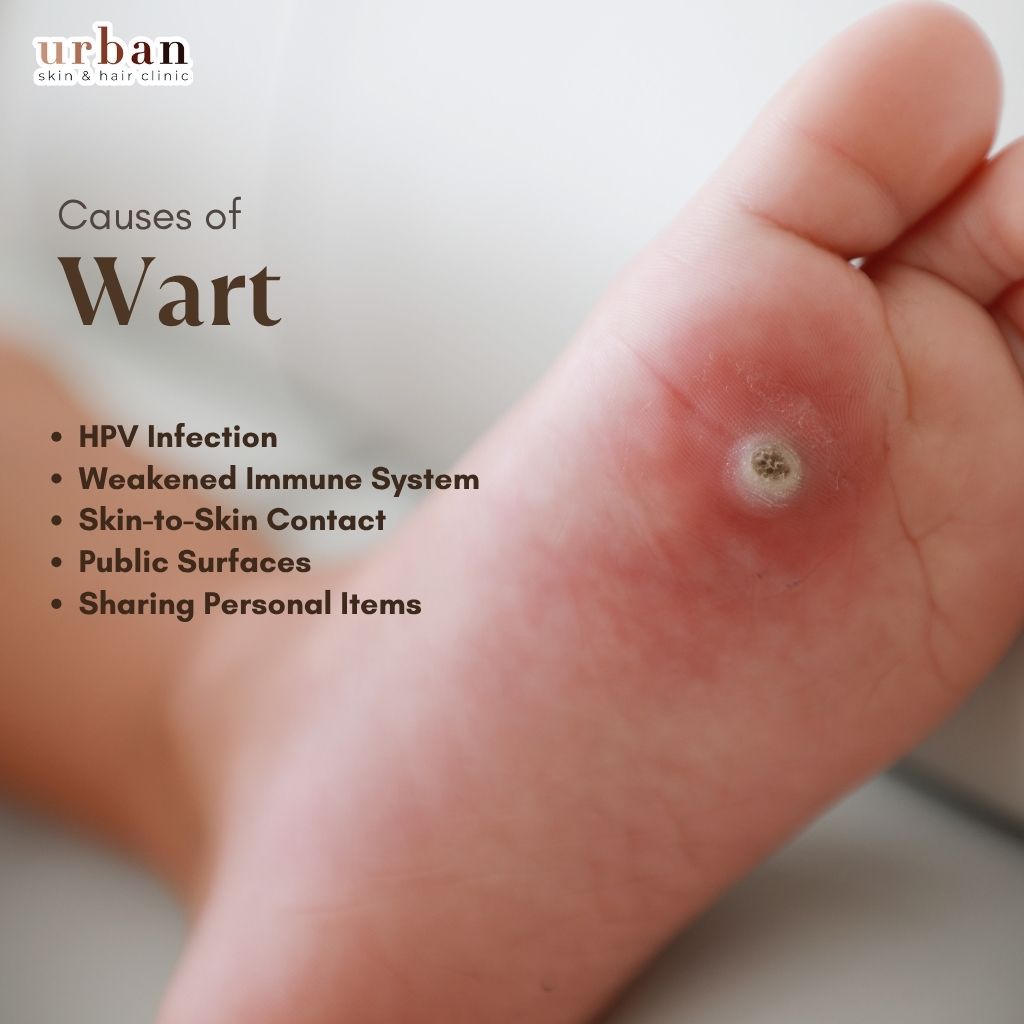 Causes of Warts