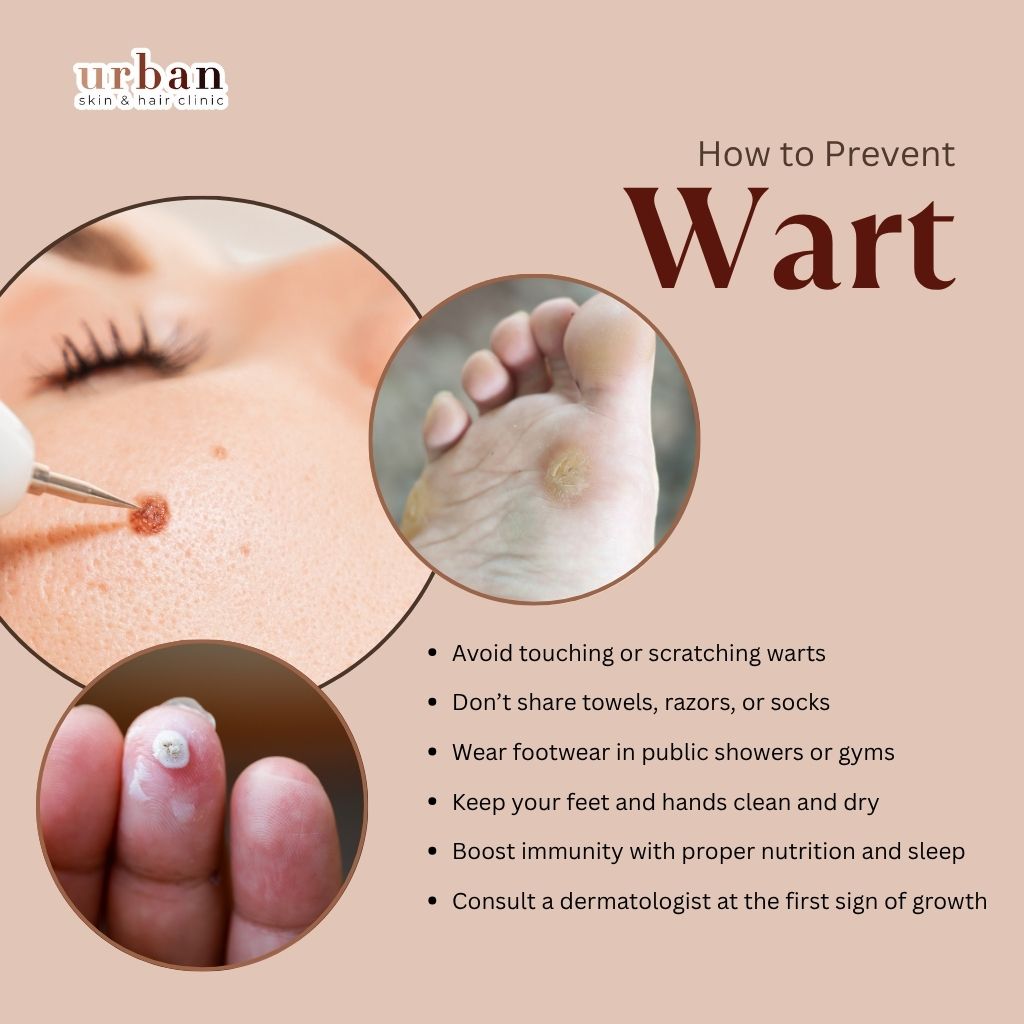 How to Prevent Warts