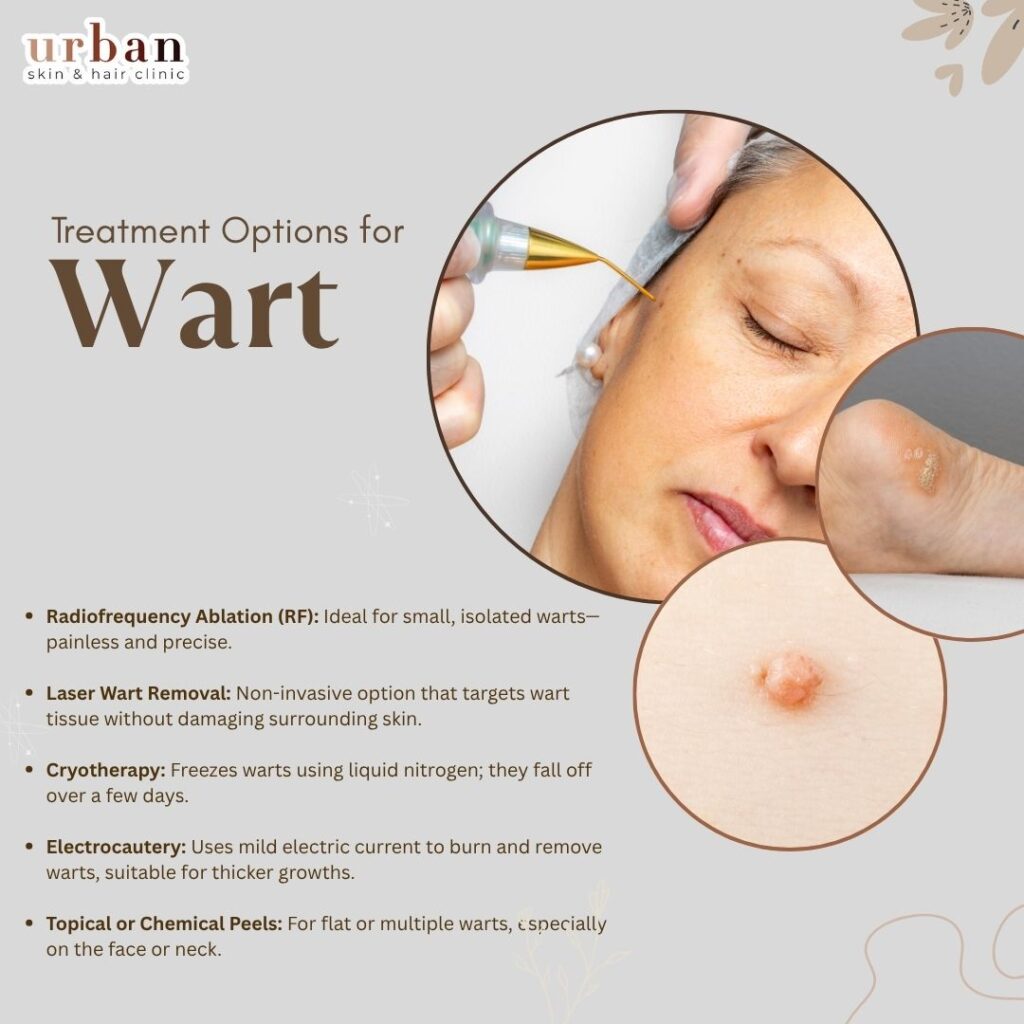 treatment for Warts