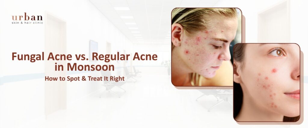 Fungal acne