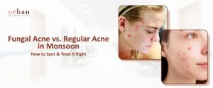 Fungal acne