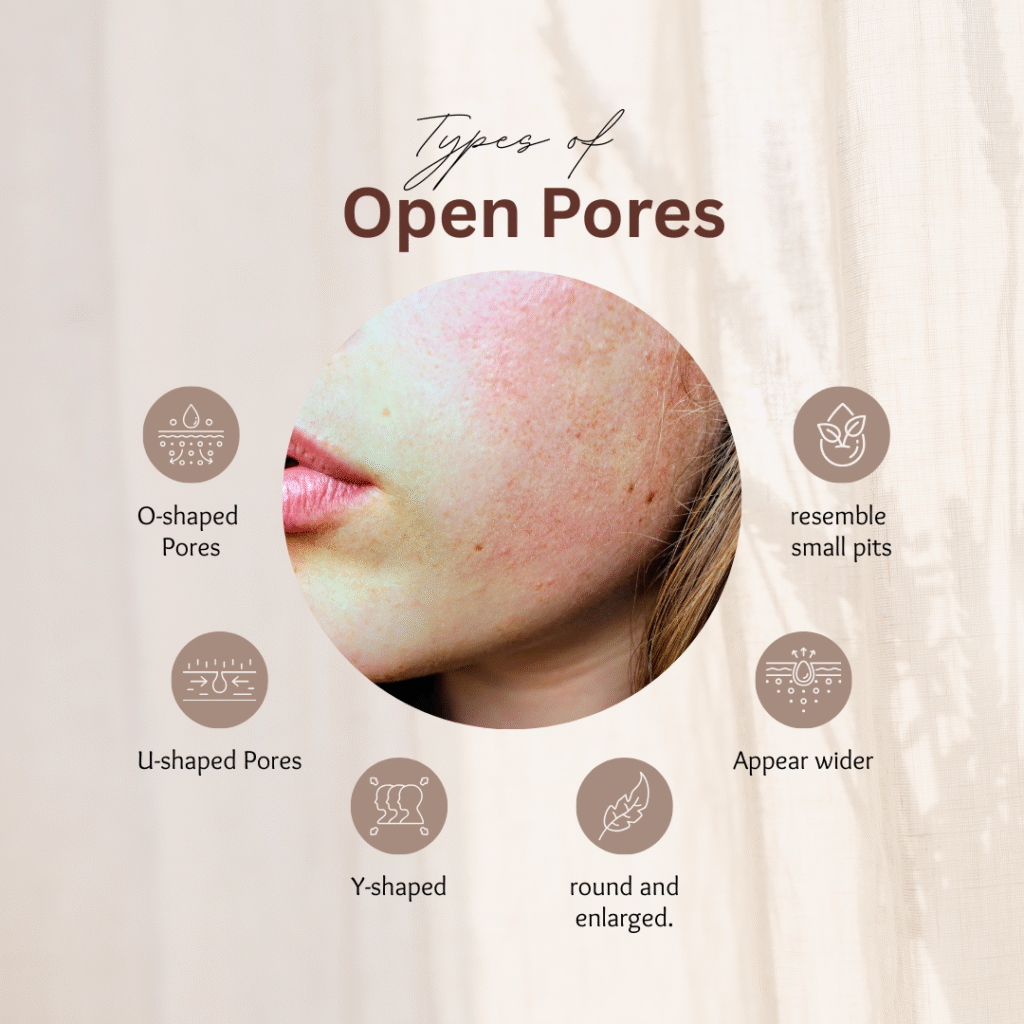 Types of Open Pores