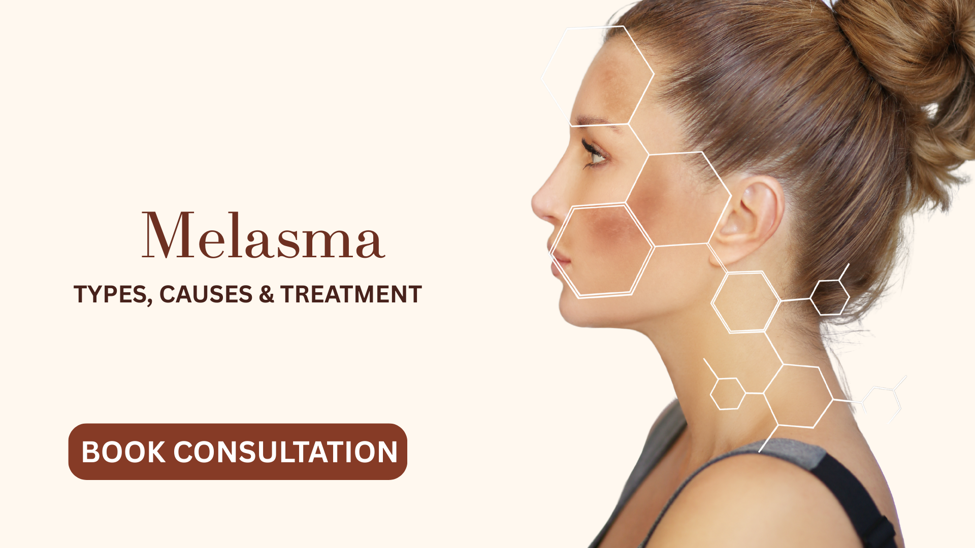 Melasma