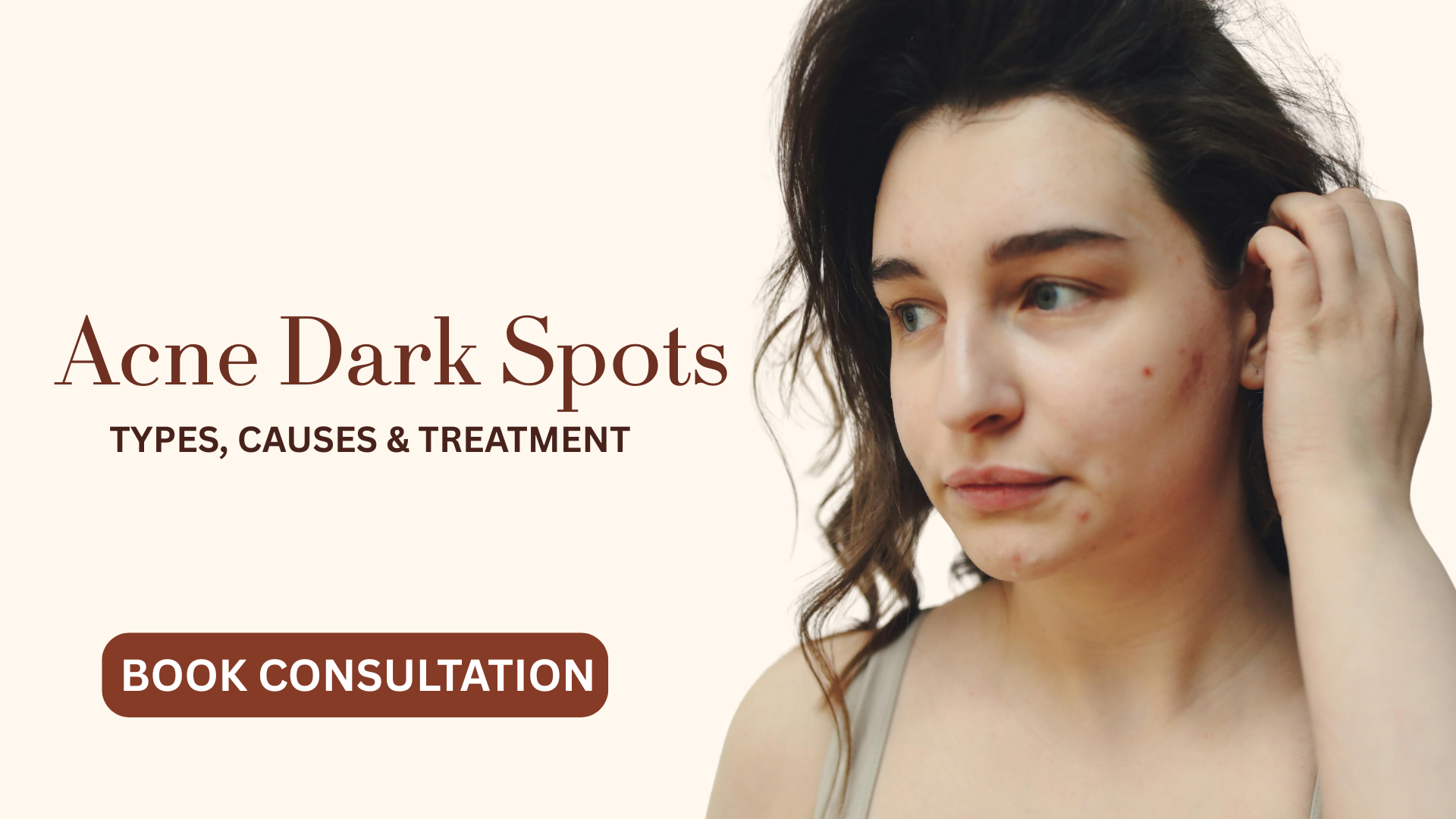 Acne dark spot