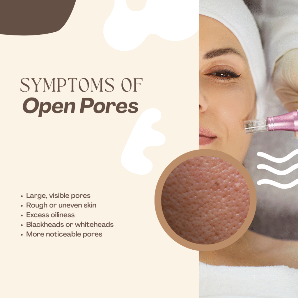 Symptoms of Open Pores