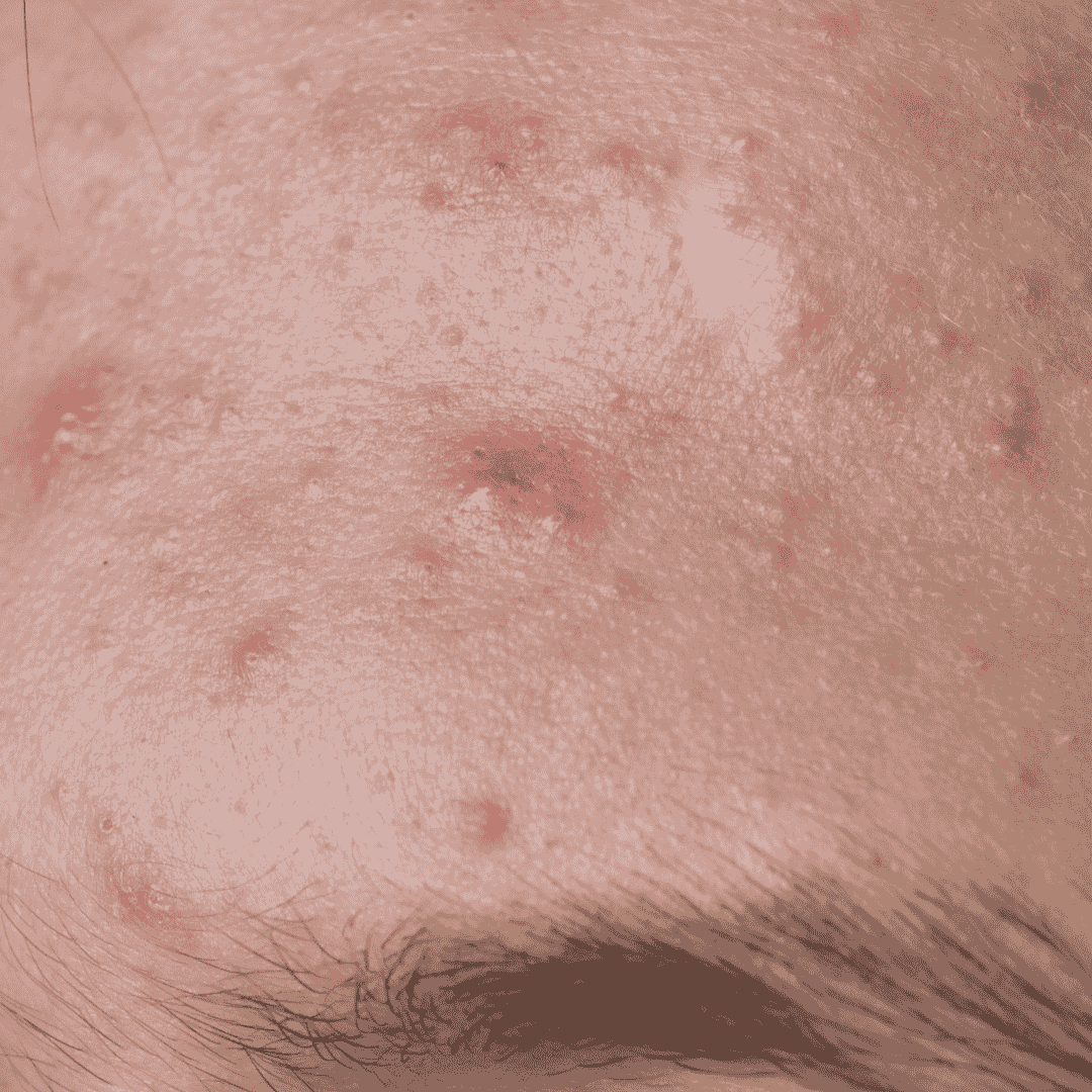 Acne Dark Spots Types, Causes, Symptoms & Treatment