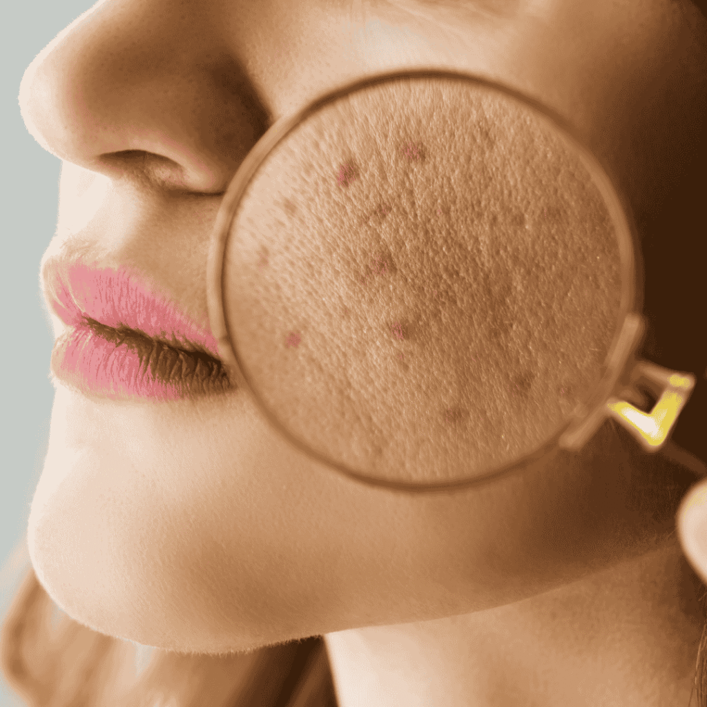 Treatment Options for Acne Dark Spots