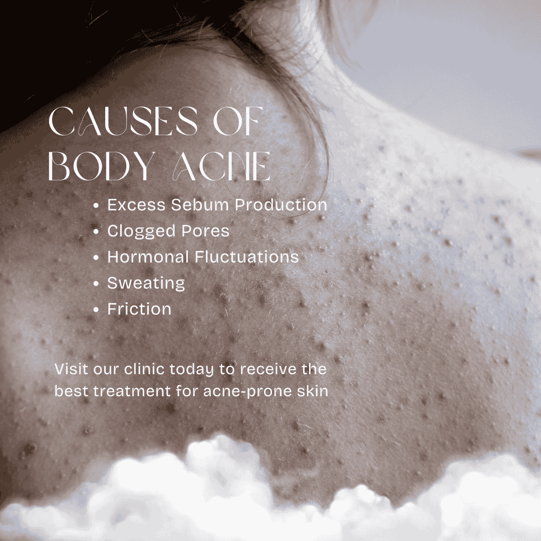 Causes of Body acne