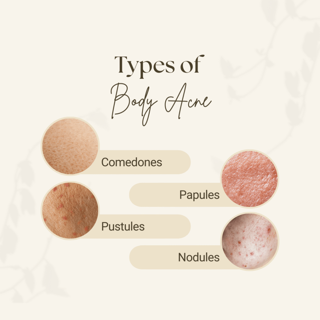 Types of Body Acne