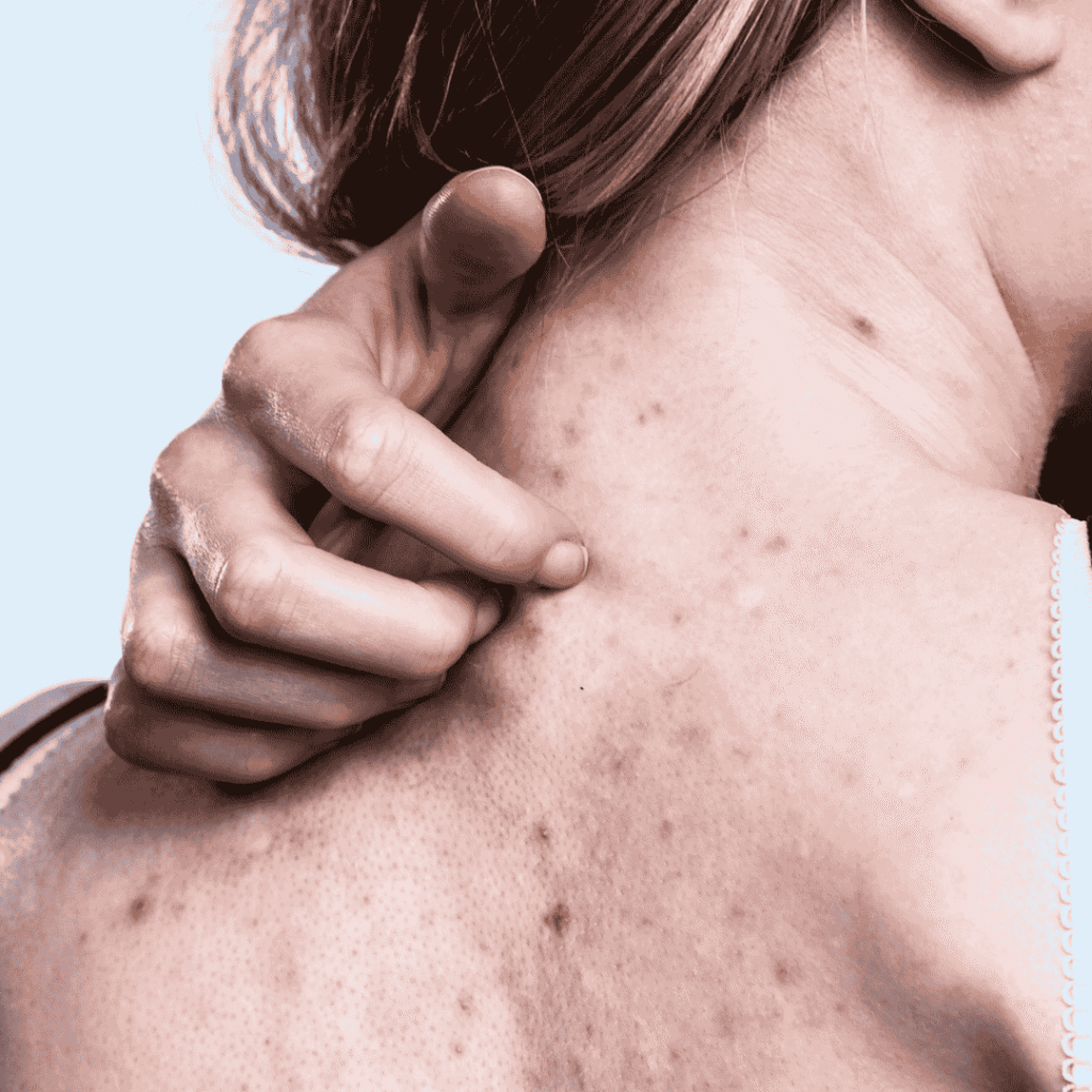 Body Acne