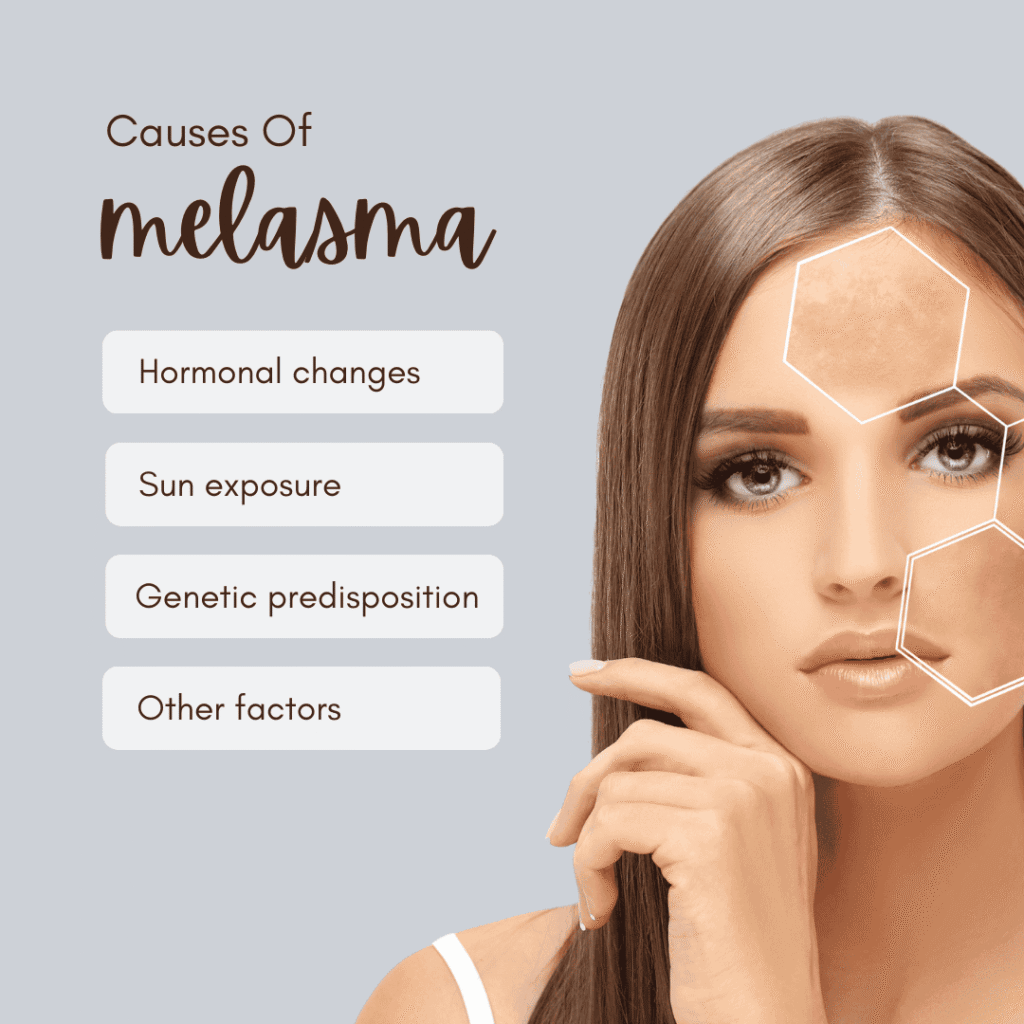 Melasma