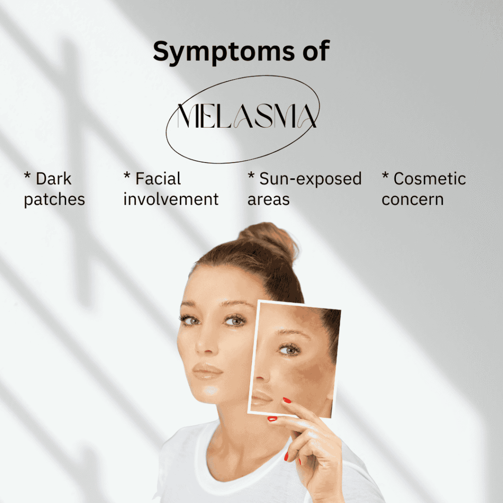 Melasma
