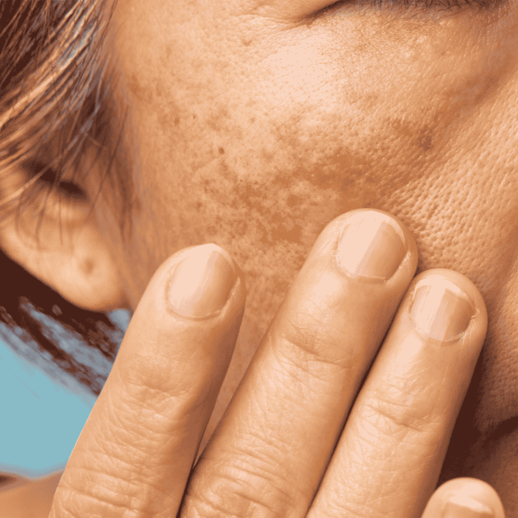 Melasma